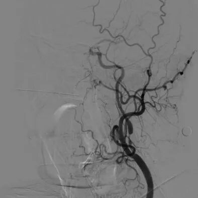波科支架怎么样​径技·第165期｜7F经桡入路下的颈动脉狭窄支架成形术一例_https://www.jmylbn.com_新闻资讯_第12张