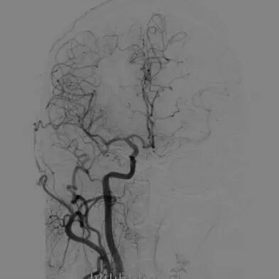 波科支架怎么样​径技·第165期｜7F经桡入路下的颈动脉狭窄支架成形术一例_https://www.jmylbn.com_新闻资讯_第10张