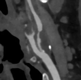 波科支架怎么样​径技·第165期｜7F经桡入路下的颈动脉狭窄支架成形术一例_https://www.jmylbn.com_新闻资讯_第4张
