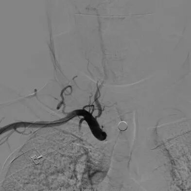 波科支架怎么样​径技·第165期｜7F经桡入路下的颈动脉狭窄支架成形术一例_https://www.jmylbn.com_新闻资讯_第14张