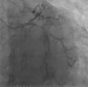 波科支架怎么样​径技·第165期｜7F经桡入路下的颈动脉狭窄支架成形术一例_https://www.jmylbn.com_新闻资讯_第20张