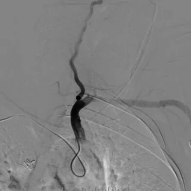 波科支架怎么样​径技·第165期｜7F经桡入路下的颈动脉狭窄支架成形术一例_https://www.jmylbn.com_新闻资讯_第17张