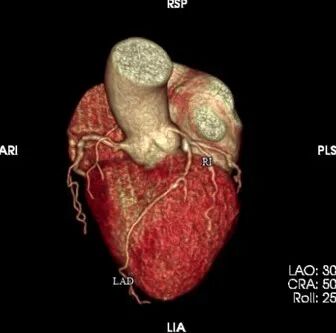 波科支架怎么样​径技·第165期｜7F经桡入路下的颈动脉狭窄支架成形术一例_https://www.jmylbn.com_新闻资讯_第5张