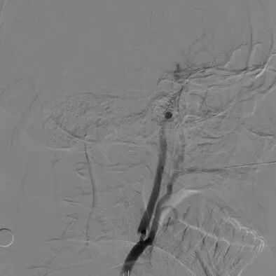 波科支架怎么样​径技·第165期｜7F经桡入路下的颈动脉狭窄支架成形术一例_https://www.jmylbn.com_新闻资讯_第9张