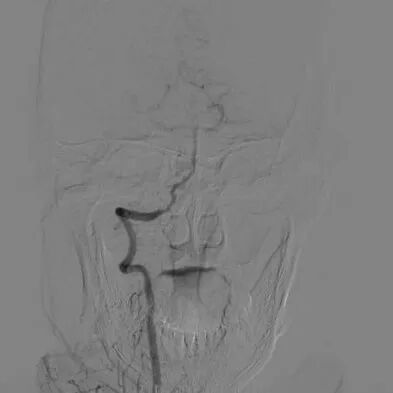 波科支架怎么样​径技·第165期｜7F经桡入路下的颈动脉狭窄支架成形术一例_https://www.jmylbn.com_新闻资讯_第15张