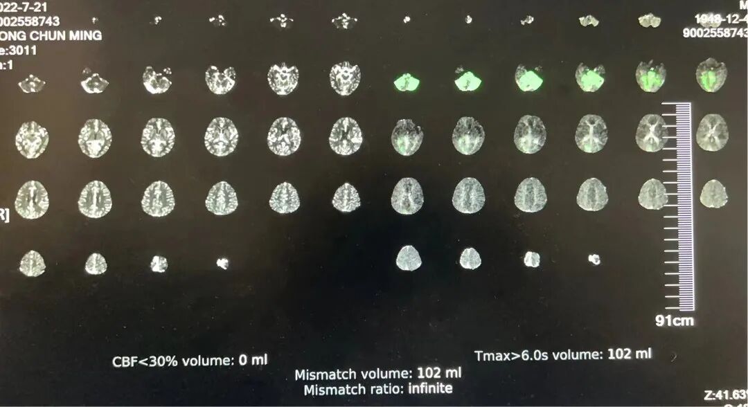 导管鞘怎么念有励可说｜Locaste长鞘及Skathi中间导管在基底动脉取栓术中的应用_https://www.jmylbn.com_新闻资讯_第16张