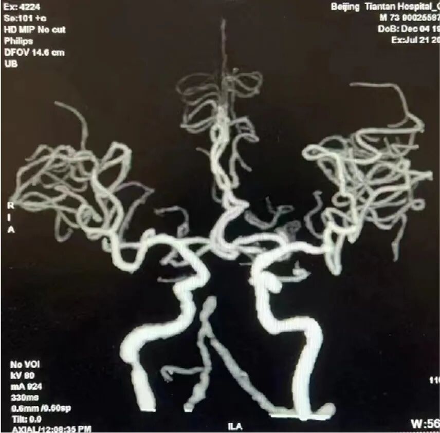 导管鞘怎么念有励可说｜Locaste长鞘及Skathi中间导管在基底动脉取栓术中的应用_https://www.jmylbn.com_新闻资讯_第14张