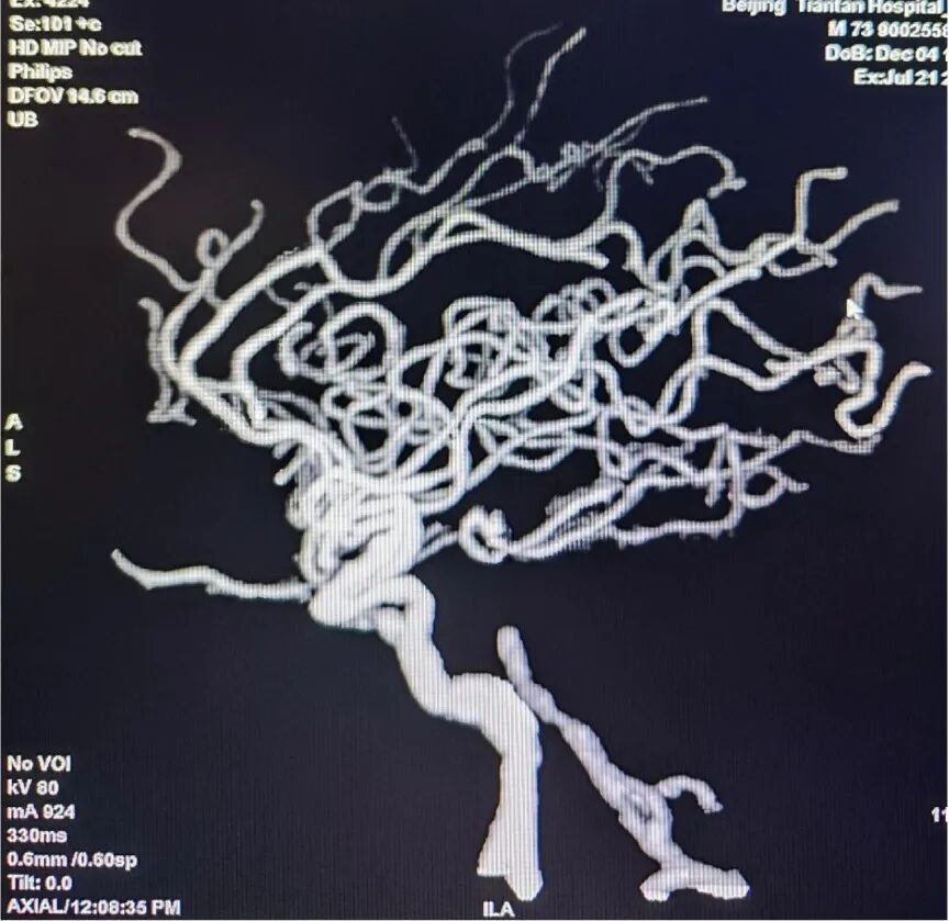 导管鞘怎么念有励可说｜Locaste长鞘及Skathi中间导管在基底动脉取栓术中的应用_https://www.jmylbn.com_新闻资讯_第15张