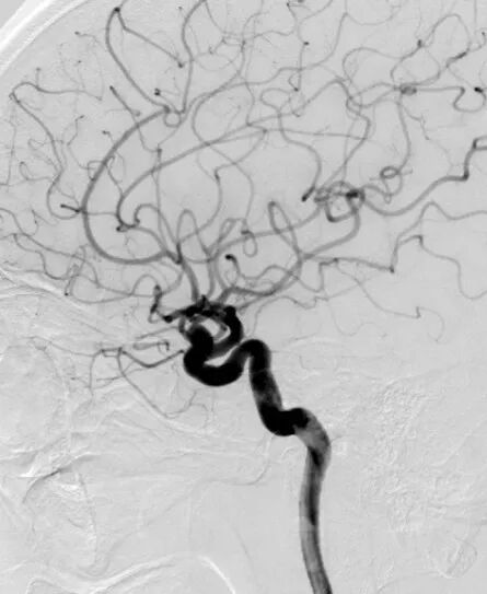 动脉长鞘怎么置入深谋远路 ｜ 千人皆翘首，万唤今始来——国内首款7F长鞘在血流导向密网支架联合弹簧圈栓塞治疗动脉瘤的首次应用_https://www.jmylbn.com_新闻资讯_第21张