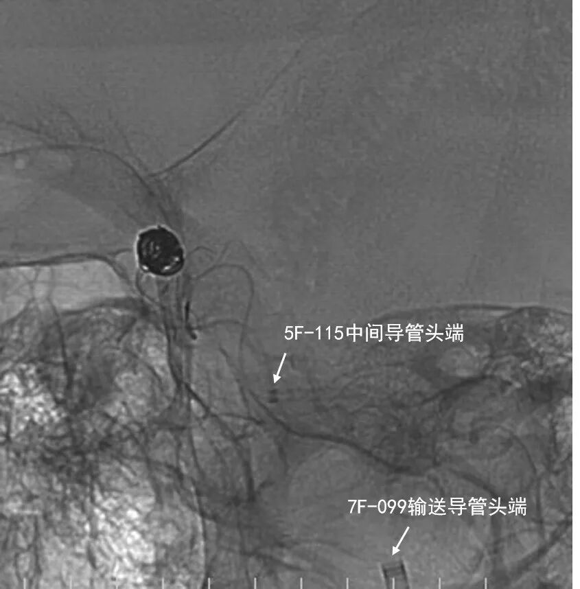 动脉长鞘怎么置入深谋远路 ｜ 千人皆翘首，万唤今始来——国内首款7F长鞘在血流导向密网支架联合弹簧圈栓塞治疗动脉瘤的首次应用_https://www.jmylbn.com_新闻资讯_第30张