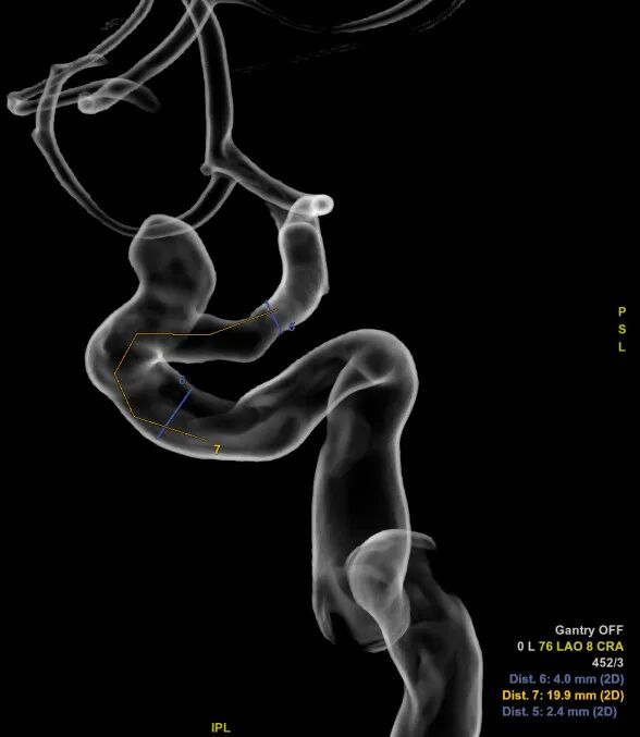 动脉长鞘怎么置入深谋远路 ｜ 千人皆翘首，万唤今始来——国内首款7F长鞘在血流导向密网支架联合弹簧圈栓塞治疗动脉瘤的首次应用_https://www.jmylbn.com_新闻资讯_第23张