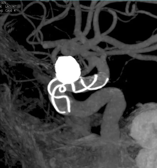 动脉长鞘怎么置入深谋远路 ｜ 千人皆翘首，万唤今始来——国内首款7F长鞘在血流导向密网支架联合弹簧圈栓塞治疗动脉瘤的首次应用_https://www.jmylbn.com_新闻资讯_第26张