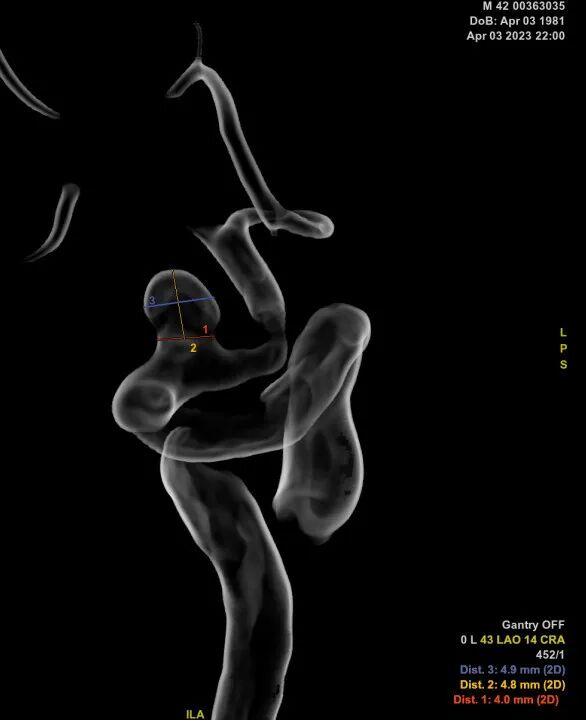 动脉长鞘怎么置入深谋远路 ｜ 千人皆翘首，万唤今始来——国内首款7F长鞘在血流导向密网支架联合弹簧圈栓塞治疗动脉瘤的首次应用_https://www.jmylbn.com_新闻资讯_第22张