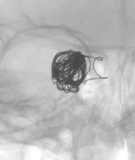 动脉长鞘怎么置入深谋远路 ｜ 千人皆翘首，万唤今始来——国内首款7F长鞘在血流导向密网支架联合弹簧圈栓塞治疗动脉瘤的首次应用_https://www.jmylbn.com_新闻资讯_第15张