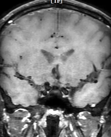 动脉长鞘怎么置入深谋远路 ｜ 千人皆翘首，万唤今始来——国内首款7F长鞘在血流导向密网支架联合弹簧圈栓塞治疗动脉瘤的首次应用_https://www.jmylbn.com_新闻资讯_第19张