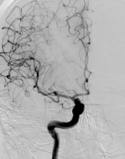 动脉长鞘怎么置入深谋远路 ｜ 千人皆翘首，万唤今始来——国内首款7F长鞘在血流导向密网支架联合弹簧圈栓塞治疗动脉瘤的首次应用_https://www.jmylbn.com_新闻资讯_第20张