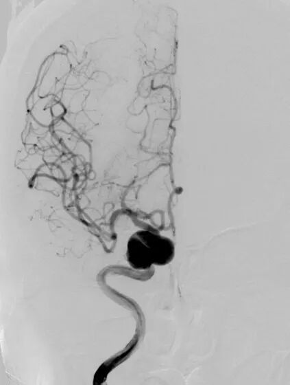 动脉长鞘怎么置入深谋远路 ｜ 千人皆翘首，万唤今始来——国内首款7F长鞘在血流导向密网支架联合弹簧圈栓塞治疗动脉瘤的首次应用_https://www.jmylbn.com_新闻资讯_第4张