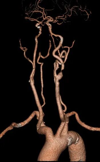 动脉长鞘怎么置入【康德莱医械】经桡介入LA长鞘+Sim II通路组合处理颈内动脉狭窄_https://www.jmylbn.com_新闻资讯_第6张