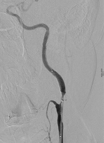 波科支架怎么样径技-弓上病例大赏｜第205期·放疗后症状性颈动脉狭窄支架置入治疗一例_https://www.jmylbn.com_新闻资讯_第17张