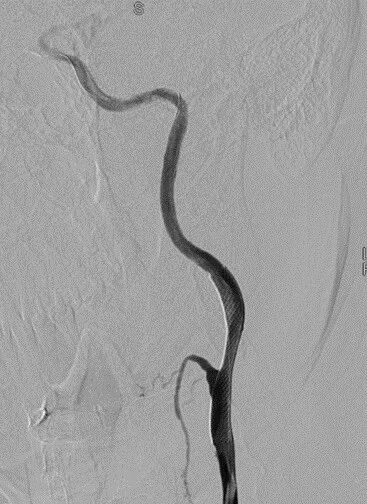 波科支架怎么样径技-弓上病例大赏｜第205期·放疗后症状性颈动脉狭窄支架置入治疗一例_https://www.jmylbn.com_新闻资讯_第18张