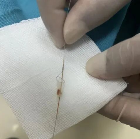 波科支架怎么样径技-弓上病例大赏｜第205期·放疗后症状性颈动脉狭窄支架置入治疗一例_https://www.jmylbn.com_新闻资讯_第20张