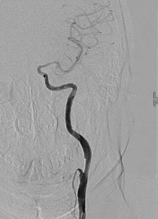 波科支架怎么样径技-弓上病例大赏｜第205期·放疗后症状性颈动脉狭窄支架置入治疗一例_https://www.jmylbn.com_新闻资讯_第19张