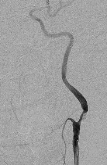 波科支架怎么样径技-弓上病例大赏｜第205期·放疗后症状性颈动脉狭窄支架置入治疗一例_https://www.jmylbn.com_新闻资讯_第16张