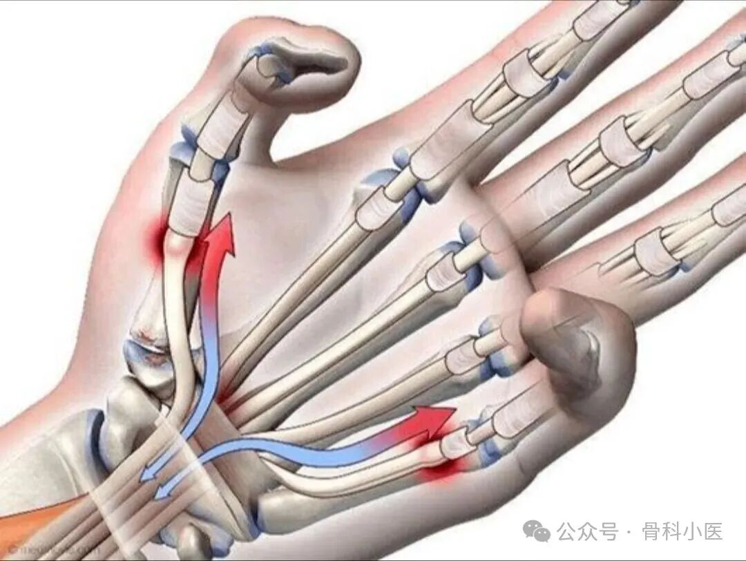 拇指狭窄性腱鞘炎的治疗方案总结--个人体会