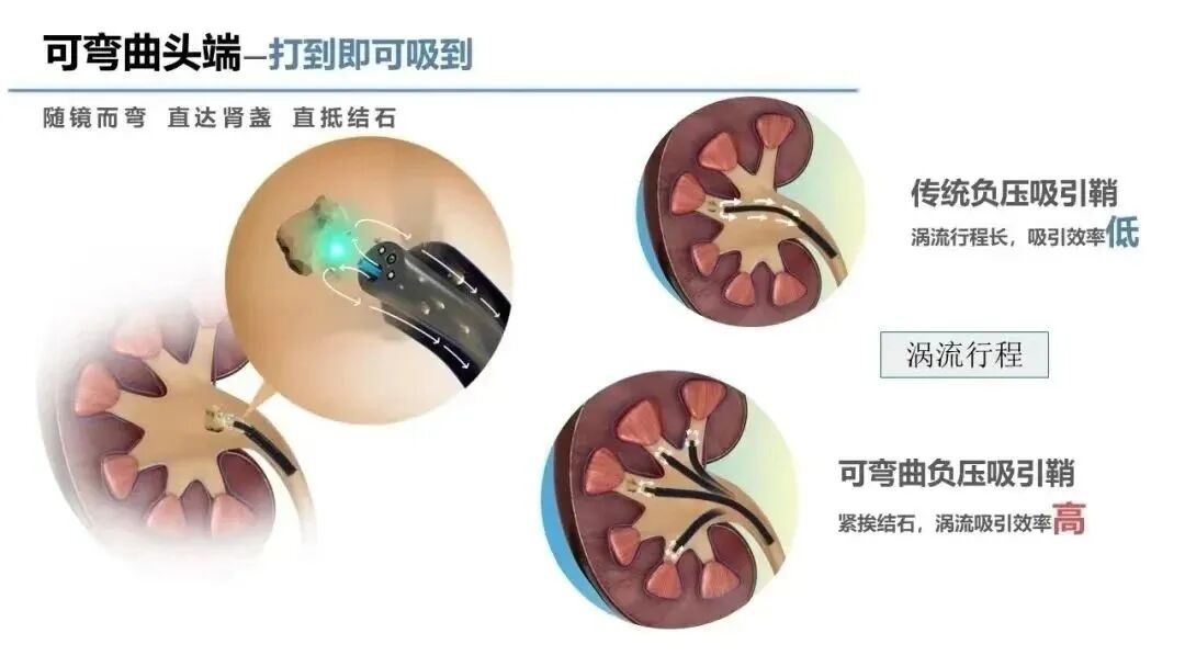 输尿管鞘是什么结石的“狙击手”——输尿管软镜结合前端可弯曲负压吸引鞘清石技术_https://www.jmylbn.com_新闻资讯_第8张