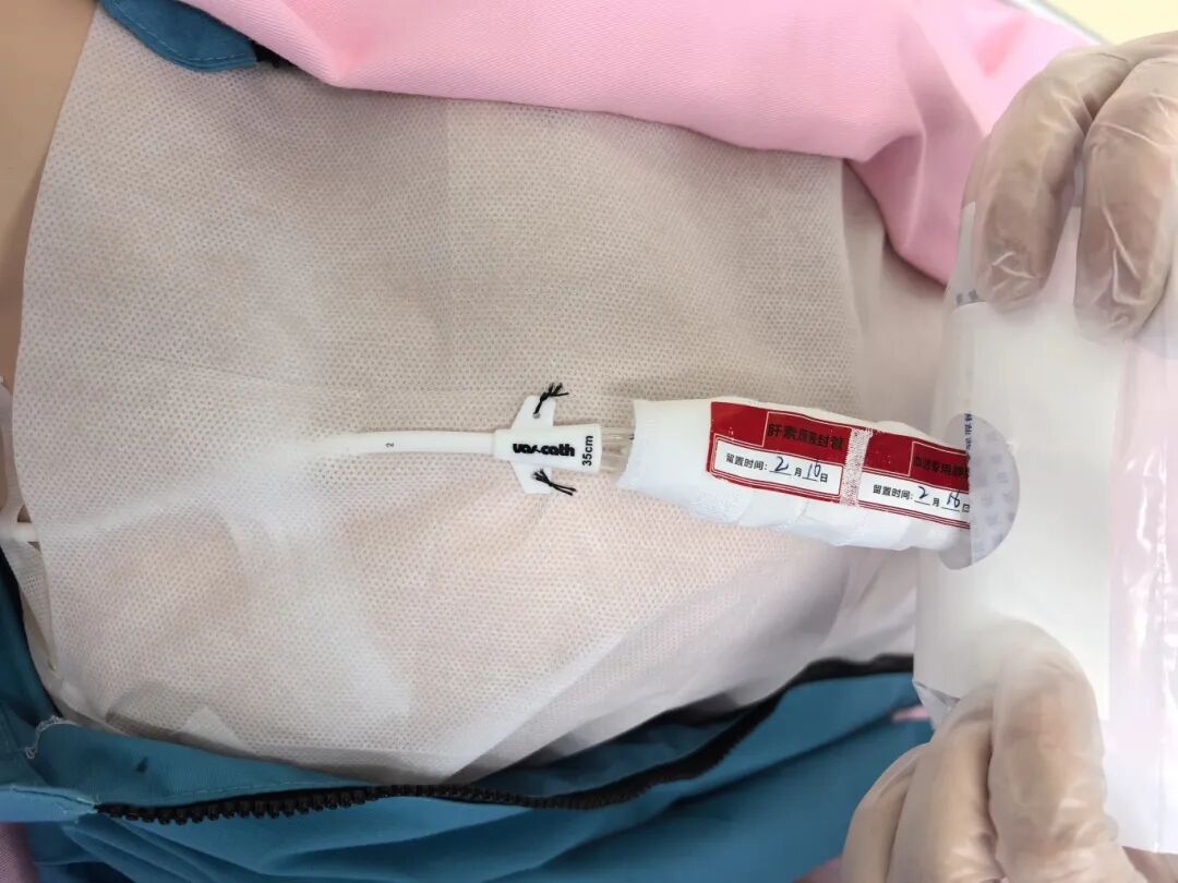 无菌纱块怎么使用一文让你学会透析导管自我换药_https://www.jmylbn.com_新闻资讯_第124张
