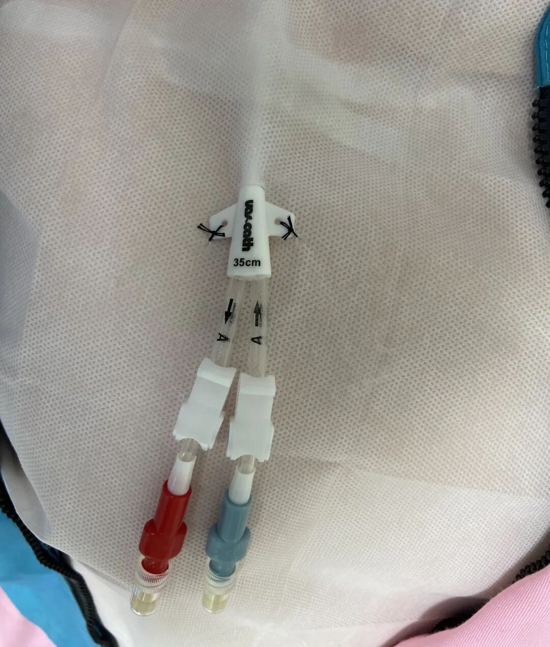 无菌纱块怎么使用一文让你学会透析导管自我换药_https://www.jmylbn.com_新闻资讯_第45张