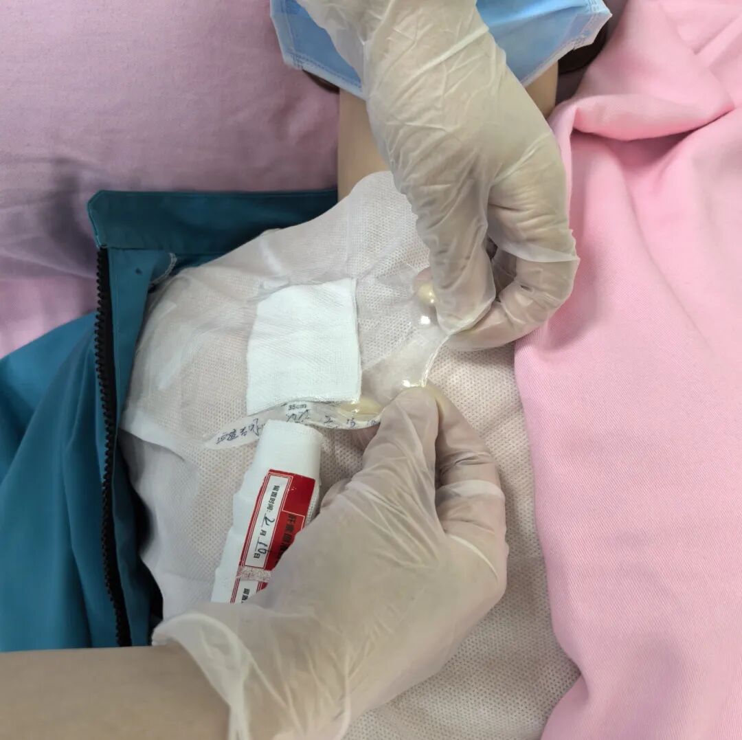 无菌纱块怎么使用一文让你学会透析导管自我换药_https://www.jmylbn.com_新闻资讯_第119张