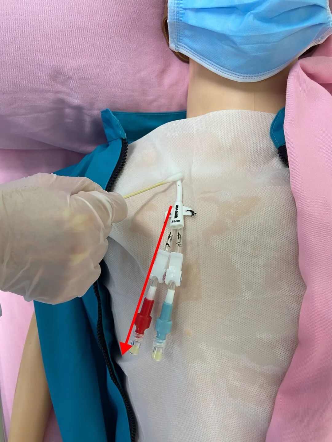 无菌纱块怎么使用一文让你学会透析导管自我换药_https://www.jmylbn.com_新闻资讯_第72张