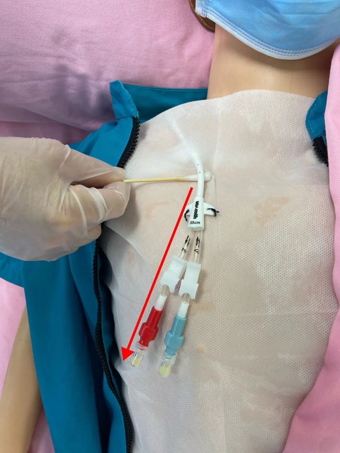 无菌纱块怎么使用一文让你学会透析导管自我换药_https://www.jmylbn.com_新闻资讯_第74张