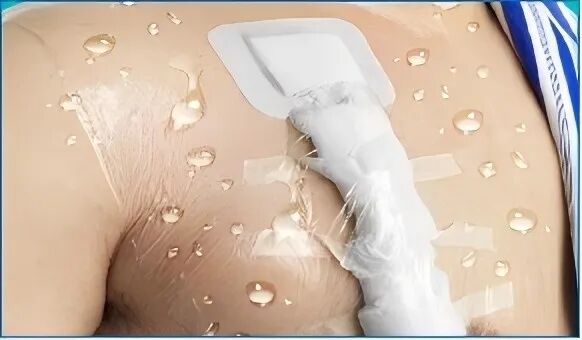 无菌纱块怎么使用一文让你学会透析导管自我换药_https://www.jmylbn.com_新闻资讯_第137张