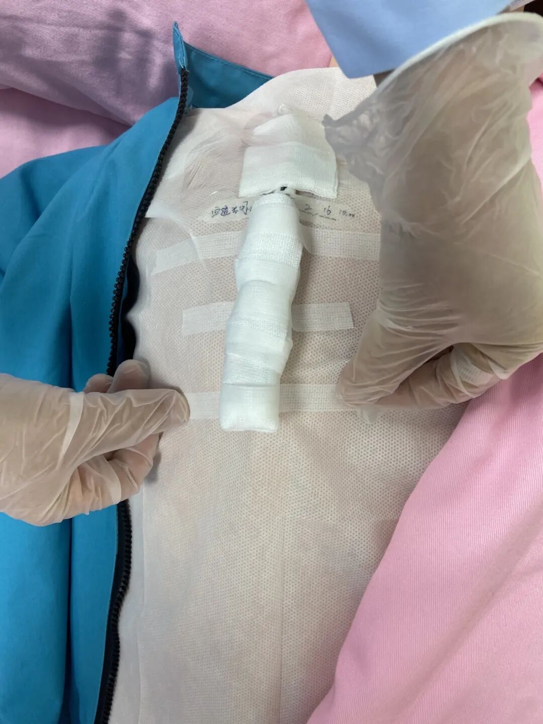 无菌纱块怎么使用一文让你学会透析导管自我换药_https://www.jmylbn.com_新闻资讯_第108张