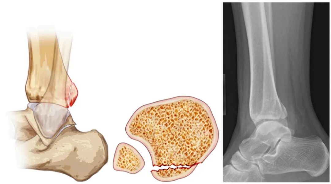 JBJS：后踝骨折、后Pilon骨折及后Pilon变异型骨折的定义与治疗