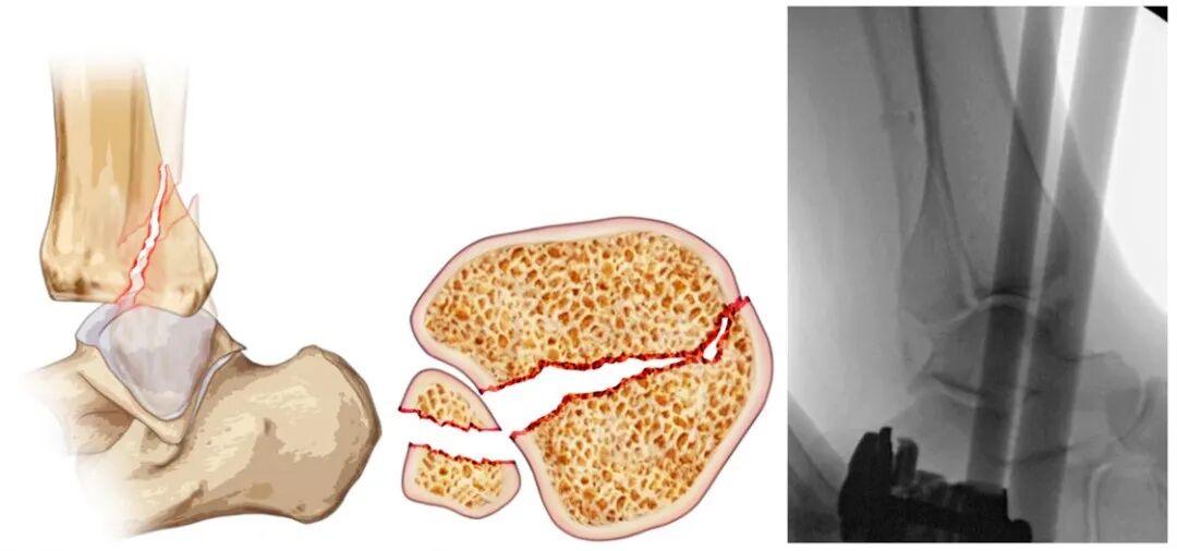 JBJS：后踝骨折、后Pilon骨折及后Pilon变异型骨折的定义与治疗
