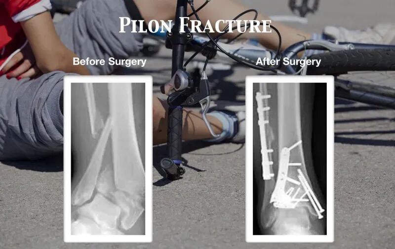 Pilon骨折：最新诊断与治疗策略