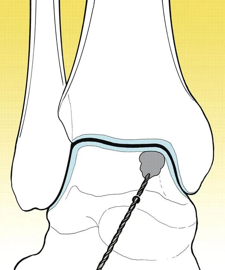 距骨骨软骨手术德国经验｜软骨成形术、逆行钻孔、微骨折术