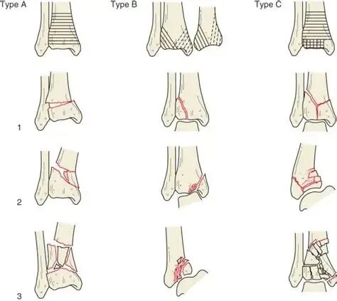 Pilon骨折：最新诊断与治疗策略