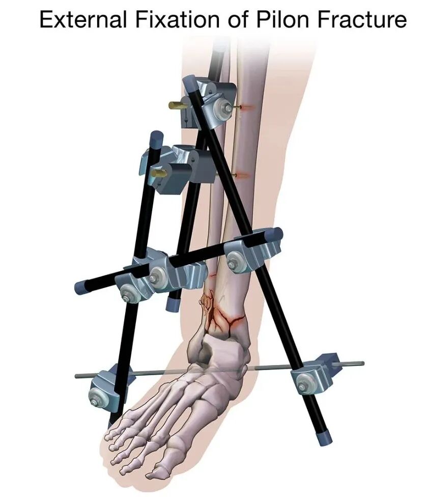 Pilon骨折：最新诊断与治疗策略