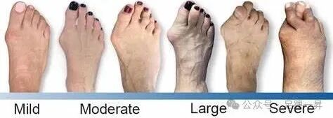 压舌板用纱布怎么包拇外翻｜术后压舌板敷料包扎技术_https://www.jmylbn.com_新闻资讯_第1张