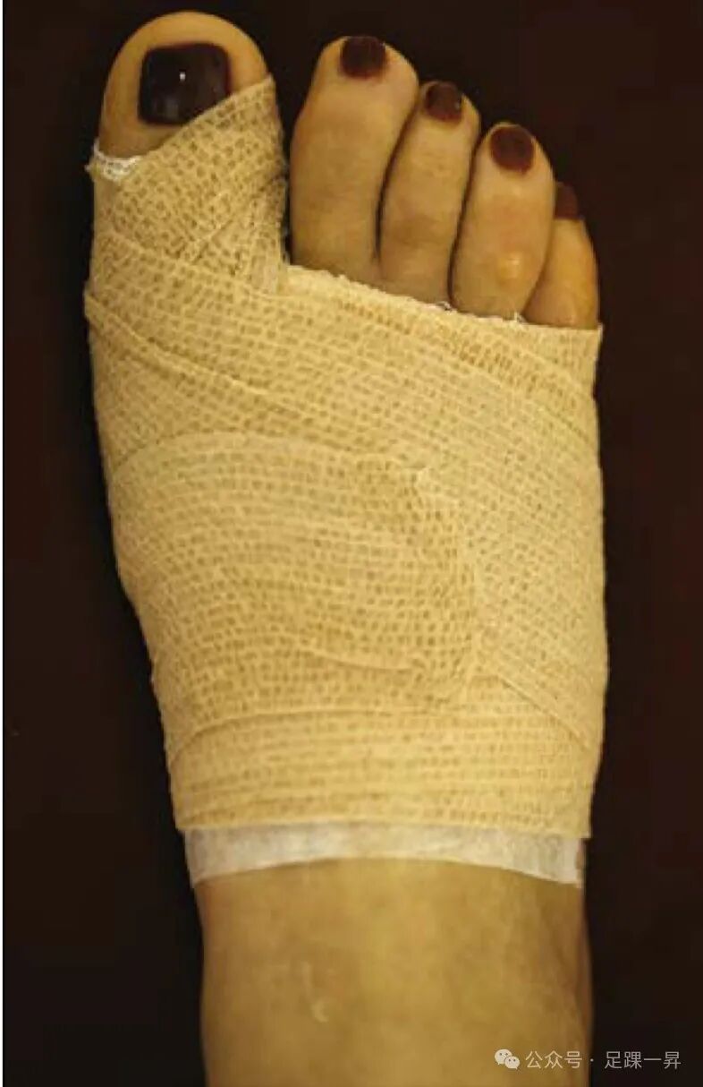 压舌板用纱布怎么包拇外翻｜术后压舌板敷料包扎技术_https://www.jmylbn.com_新闻资讯_第4张