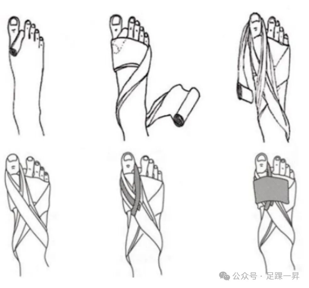 压舌板用纱布怎么包拇外翻｜术后压舌板敷料包扎技术_https://www.jmylbn.com_新闻资讯_第5张