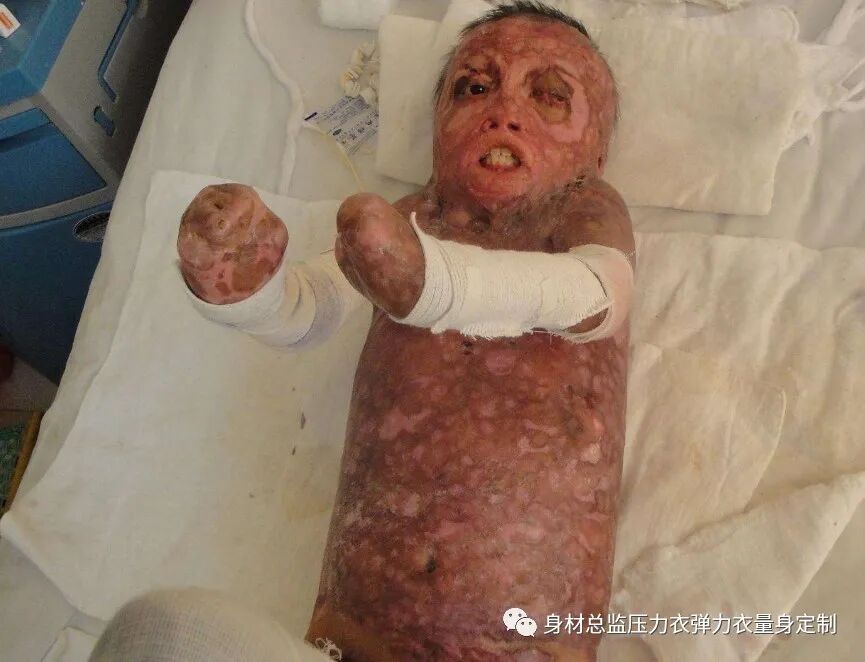 医用夹板怎么软化烧伤患者避免走弯路必读！！！烧伤康复指南--物理治疗、职业治疗、烧伤疤痕挛缩、烧伤压力衣弹力衣定制_https://www.jmylbn.com_新闻资讯_第2张