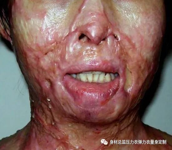 医用夹板怎么软化烧伤患者避免走弯路必读！！！烧伤康复指南--物理治疗、职业治疗、烧伤疤痕挛缩、烧伤压力衣弹力衣定制_https://www.jmylbn.com_新闻资讯_第1张