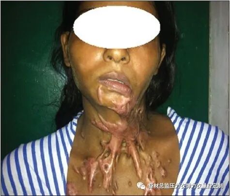 医用夹板怎么软化烧伤患者避免走弯路必读！！！烧伤康复指南--物理治疗、职业治疗、烧伤疤痕挛缩、烧伤压力衣弹力衣定制_https://www.jmylbn.com_新闻资讯_第10张