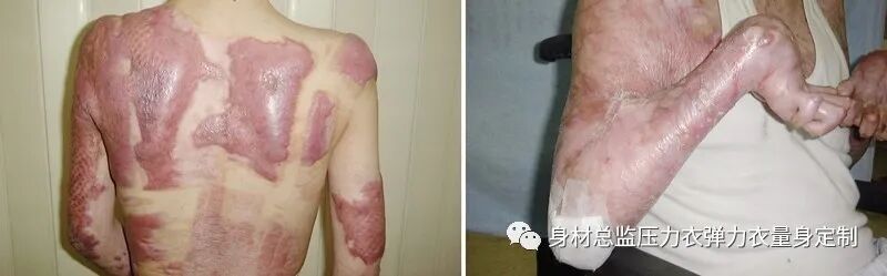 医用夹板怎么软化烧伤患者避免走弯路必读！！！烧伤康复指南--物理治疗、职业治疗、烧伤疤痕挛缩、烧伤压力衣弹力衣定制_https://www.jmylbn.com_新闻资讯_第13张