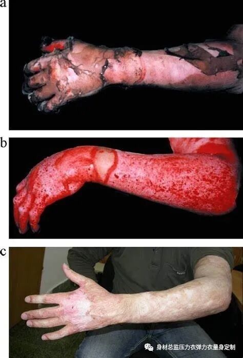 医用夹板怎么软化烧伤患者避免走弯路必读！！！烧伤康复指南--物理治疗、职业治疗、烧伤疤痕挛缩、烧伤压力衣弹力衣定制_https://www.jmylbn.com_新闻资讯_第8张